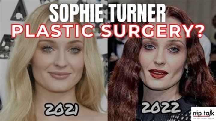 
Did Sophie Turner Get Plastic Surgery? Who is Sophie Turner? 