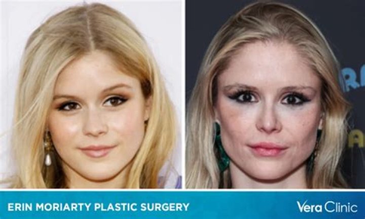 
Erin Moriarty Plastic Surgery Rumors! Did The Famous Actress Go Under The Knife? Find All You Need Here! 